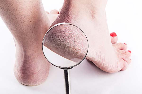 What vitamins are missing if your heels are cracked?